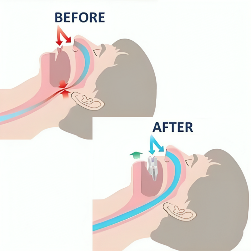 Anti-Snoring MouthGard